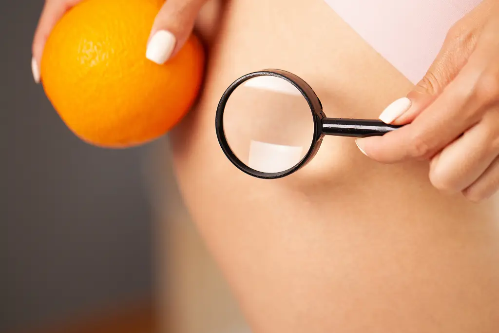 Tratamientos para reducir la celulitis